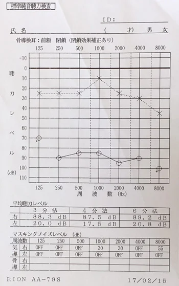 耳鳴りの原因｜ストレスで血流が低下した顔（治療前）