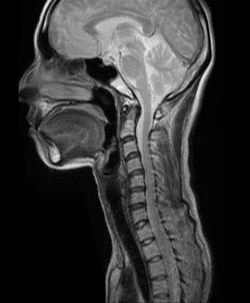 脳脊髄液減少症(MRI検査)