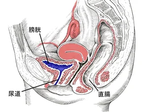 間質性膀胱炎（治療前）