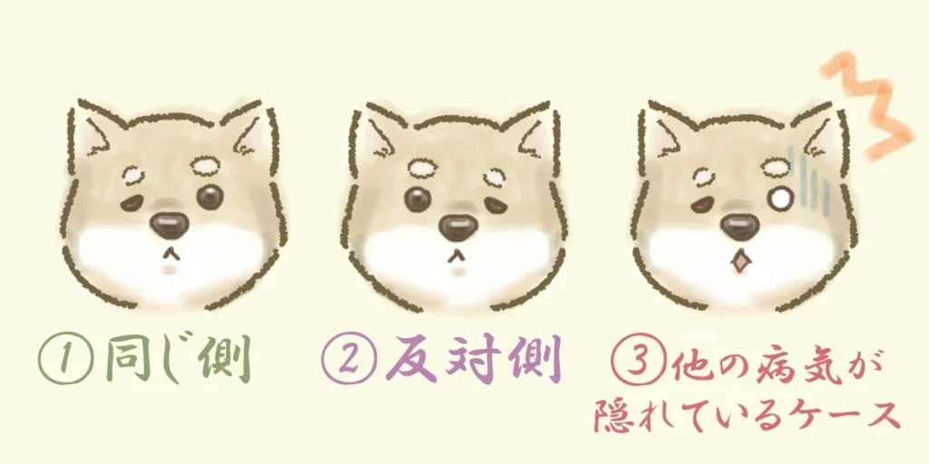 顔面神経麻痺再発の3パターンをご紹介